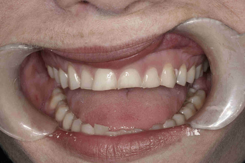 patient's teeth before dental treatment