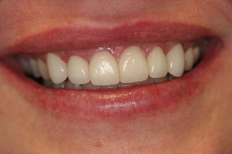 patient's teeth after dental treatment