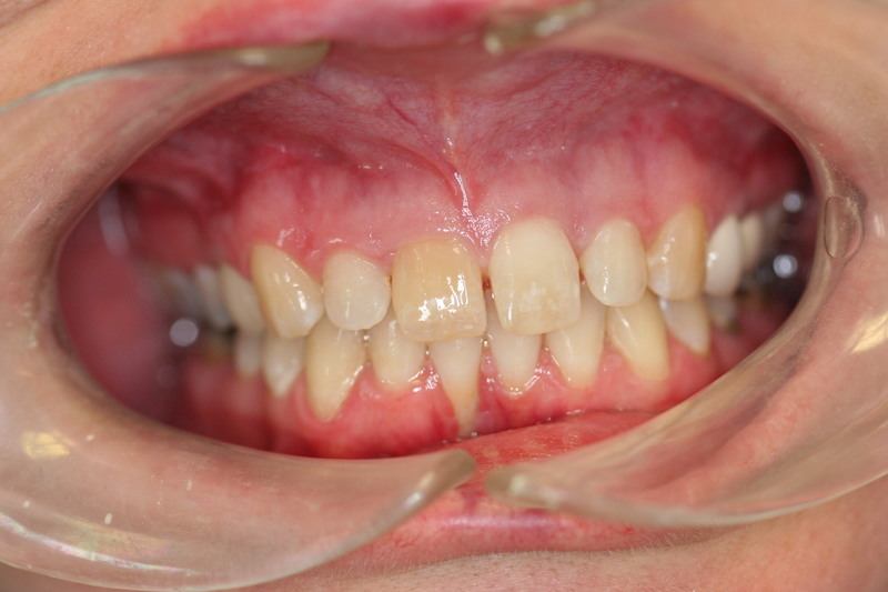 patient's teeth before dental treatment