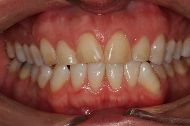 patient's teeth before dental treatment