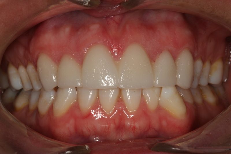 patient's teeth after dental treatment