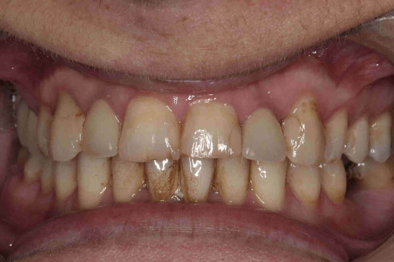 patient's teeth before dental treatment
